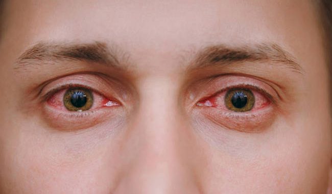 Κοκκίνισμα ματιών: 5 κοινές αιτίες & πώς θα το προλάβετε